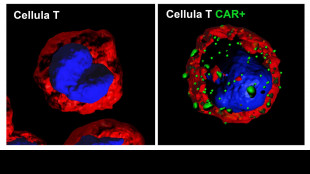 Linfomi, il 70-75% dei pazienti può guarire o vivere a lungo